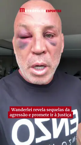 Wanderlei Silva apareceu nas redes sociais, nesta quarta-feira (1º/10), para comentar sobre as sequelas da confusão após a luta contra Popó. O lutador ainda anunciou que irá processar Rafael Freitas, que o nocauteou durante a invasão ao ringue. “Todo ato criminoso tem que ser julgado pela Justiça e eu vou atrás dela”, declarou o ex-atleta de MMA. Na publicação, ele ainda escreveu: “As consequências de um ataque traiçoeiro e que já tinha sido anunciado, a indignação, a dor e a revolta de quem deveria ter sido protegido e que hoje suporta os traumas físicos e psicológicos de uma ação criminosa.” 📹  Reprodução/ Wanderlei Silva