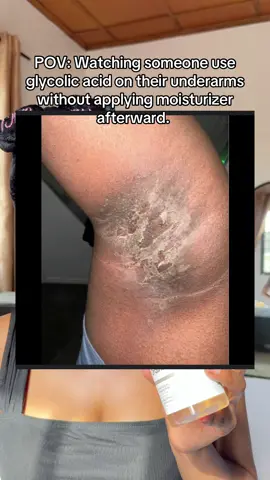 Always make sure to moisturize after using glycolic acid skipping moisturizer after using glycolic acid is bad and  can cause burnt underarms or rashes. video: #theordinaryglycolicacid #darkarmpits  #skincaretips #skincaremistakes 