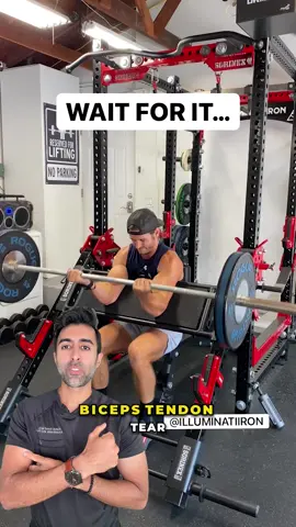 Have you ever seen both biceps tear at once? It’s rare, but when it happens, you’ll usually hear a pop and see that classic bulge in the upper arm. Follow @doctorsoood to improve your health IQ and for similar content. vc: illuminatiiron #bicepstear #popeyedeformity #orthopedics #injuryprevention #gyminjury #healthtips