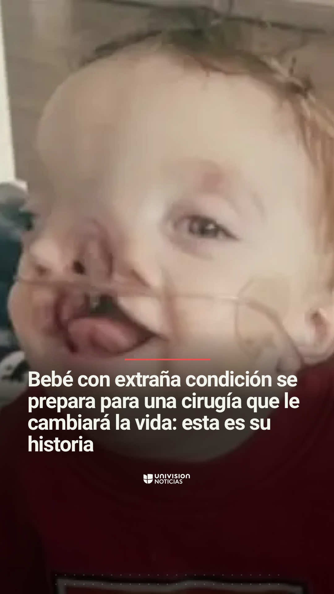 👶🩺 Este bebé con extraña condición se prepara para una cirugía que le cambiará la vida. Brody Shain, de 1 año, nació en Texas con un defecto congénito que provocó que su tejido cerebral creciera a través de su cráneo y dividiera su pequeño rostro en dos partes. Al pequeño le realizarán la primera de varias cirugías que necesita para reconstruirle su carita, hacer que respire bien, se pueda alimentar mejor y logre sonreír con facilidad. Te lo cuenta Andrea León.  📺 Más del @Edición Digital a las 12pm/11C. #DeformaciónCongénita #Salud #bebé #bebés #cirugías