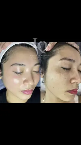 Sạch nám#chamsocdamun#chamsocdaseo#chamsocda#chamsocdanam#tanbinh       