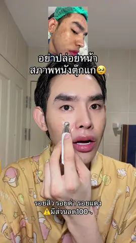 #สตอคอนซีรั่ม #รอยสิว 