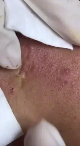 Nặn mụn đúng cách#mụn #điềutrịmụn #yenspa #nặnmunbangtay #nanmun 