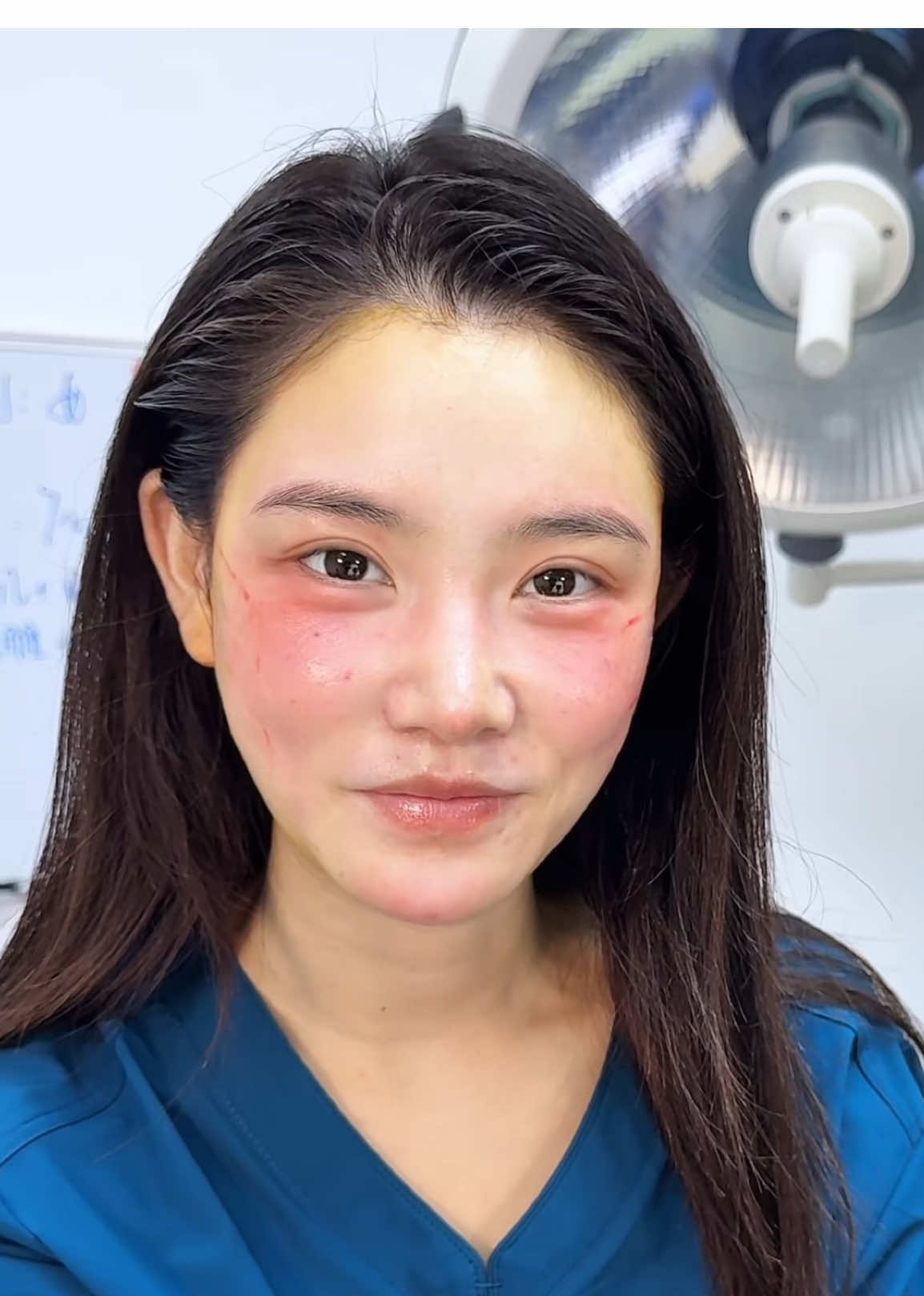 ✨ From Puffy to Perfectly Defined ✨ Too much filler in the midface can weigh you down, causing sagging and deep smile lines. With the 9D Facelift, we refined the contours — lifting the cheeks back to their natural position, making the face lighter, slimmer, and beautifully structured. 💎 #9DFacelift #FacialLift #NaturalAesthetics #YouthfulGlow #FacialRejuvenation     