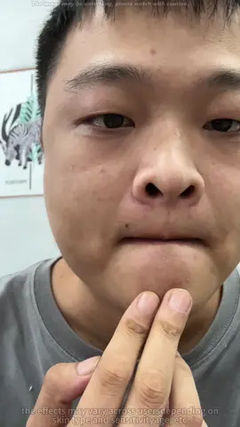 Blackhead removed #blackheads #skincare #doublecleansing #cleanser #kbeauty 