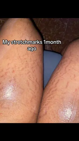 #fyppppppppppppppppppppppp #stretchmarkremoval #foryoupage #skincare #stretchmarks 