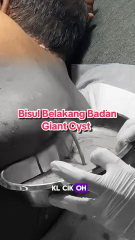 Detik-detik cemas! Lajuuu dia keluar macam air terjun  Cyst bercampur dengan nanah warna coklat pekat macam nestum warna dia hehe Kita terpaksa sensor … maaf ya 🙏 #fyp #DrWalid #minorsurgery #Cyst #Bisul 