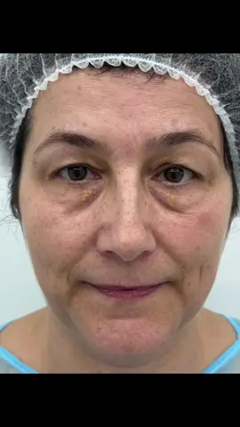 Cat timp crezi ca a trecut de la intervenție? #drlevymedicalcenter #plasticsurgeonsoftiktok #blefaroplastica #blefaro #smile 