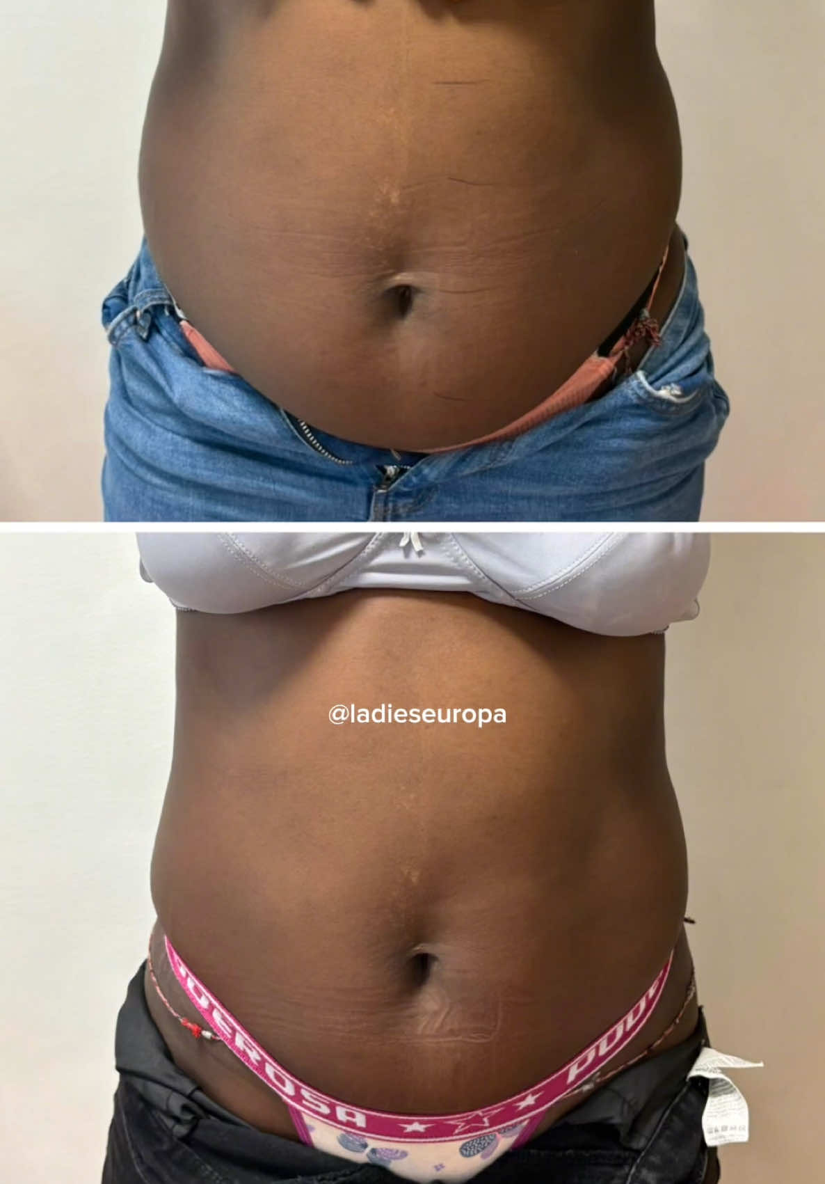 Emagrecimento em poucas sessões ✨❤️ Lisboa 📍#lisboa #estetica #portugal #fy #foryou 