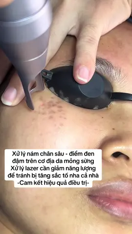 Nám chân sâu lazer #trendingtiktok #viral #LearnOnTikTok #trendingvideo #lazer 