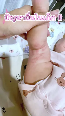 ปัญหาผื่นในเด็กเล็กเป็นเรื่องที่รำคาญใจมากๆ เพราะเด็กน้อยไม่สามารถใช้ยาทาตัวอื่นๆได้เหมือนผู้ใหญ่ จะทาคาลาไมด์ก็จะเลอะเสื้อผ้าอีก แค่พอเจอ cara allantoin soothing cream คือแก้ปัญหาเรื่องนี้ได้ดีมาก 💕