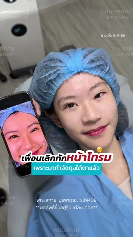 เพื่อนเลิกทัก หน้าโทรม‼️ เพราะมา #กำจัดถุงใต้ตา ✨ #กำจัดถุงใต้ตาแผลใน #หมอสกาย #skyclinic #ทำตาที่ไหนดี