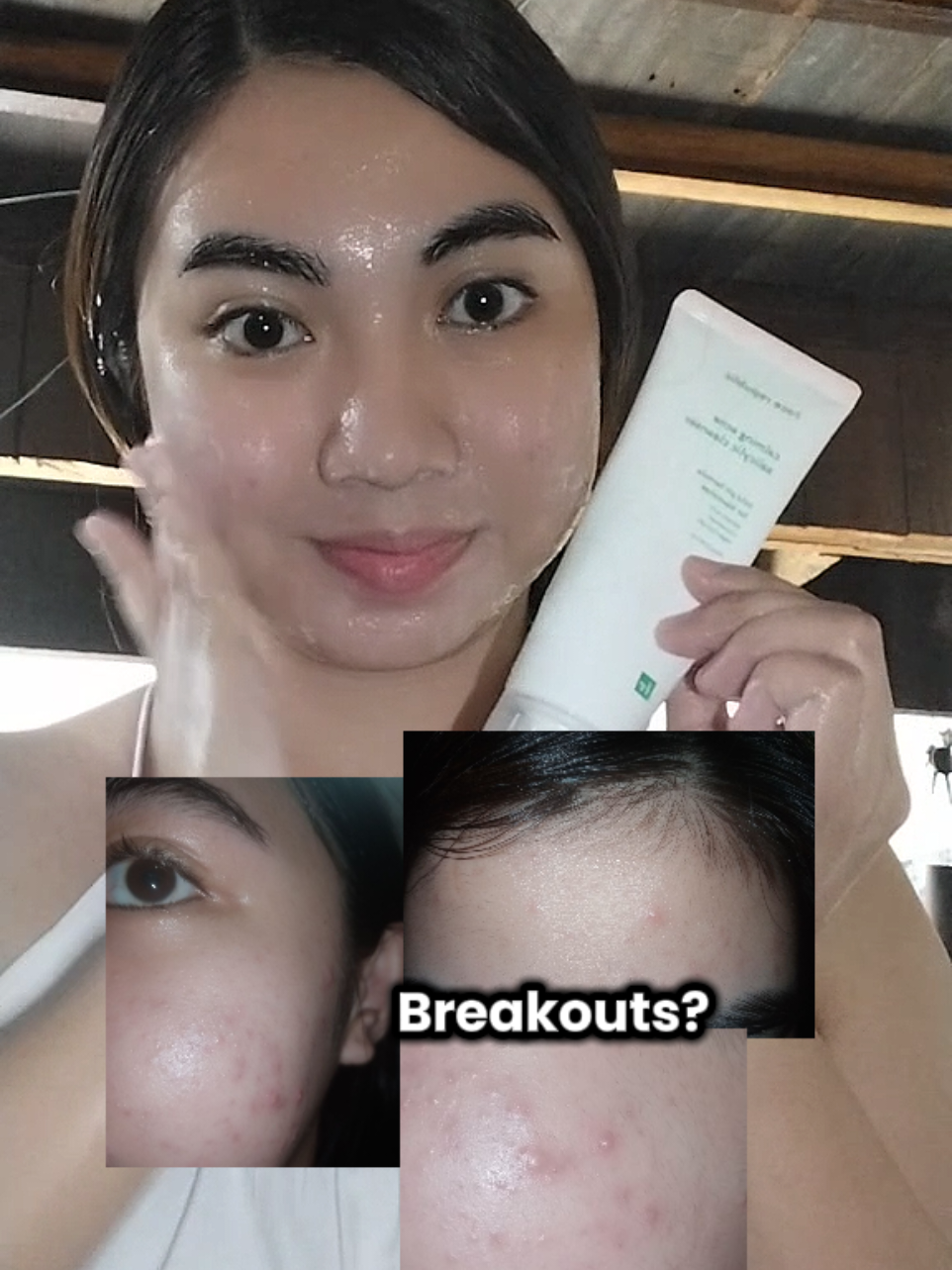 Only pimple marks are left 🫣 #TheFaceRepublic #gentlecleanser #AcneSolution 