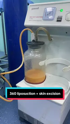 Results after 7 days of liposuction #Dr_lee #liposuction #philippines 