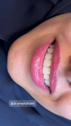 تجميل مريح للعين بقشور الفلدسبثك #فينيرز #فينير #veneer #قشور #د.اروى.الطحامي 