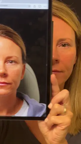 This video shows a patient in her early 40’s she is 6 months post-op upper eyelid surgery.  #upperblepharopasty #naturalresultsonly #upperlidbleph #rejuvenation #bostontiktok 