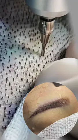 No eyebrows, do this, advanced and age-reducing#hairtransformation #eyebrow #hairstyle #hairline #пересадкабровей #eyebrowtransformation #变美 #眉毛アート #植眉 #becomebeautiful #种植睫毛 #eyelashes #eyelashtransformation 