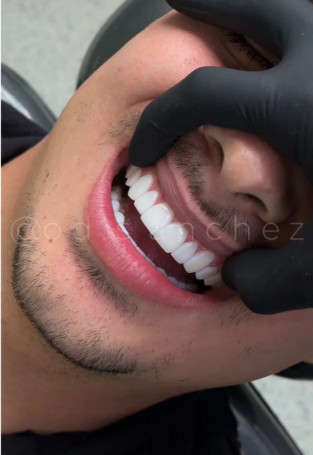 Show off your brand-new smile!🤩💎 We design your perfect smile with the color, shape, and size you choose. From super-natural shades to ultra-bright whites, there’s a style for everyone😍