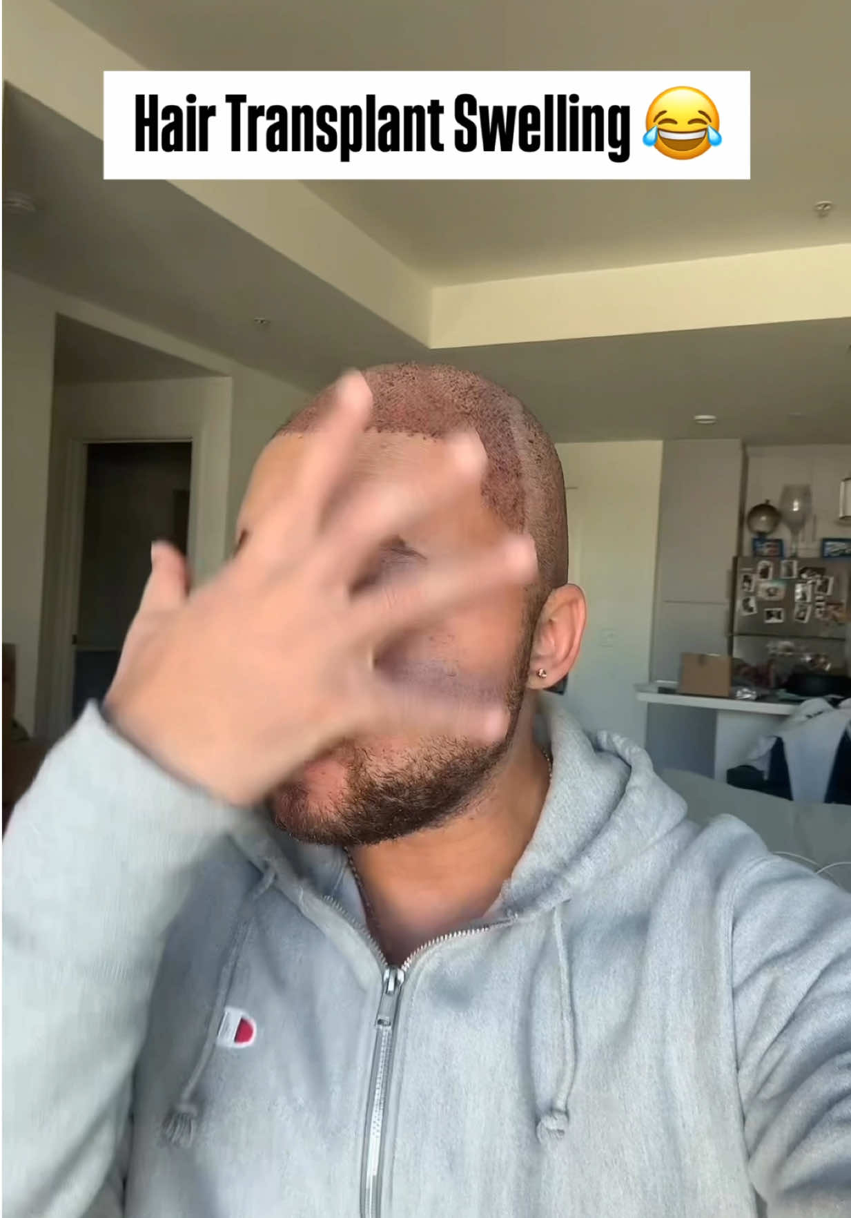 Recovering bald man   #viralreels #influencersinthewild #johnjonne #BlackTikTok #explorereel #explorepage #Lifestyle #funnyreels #fyp #funnyvideos #trending #viral #SelenaGomez #martin #martinlawrence 
