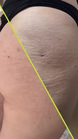 Inkless Stretch Marks Treatment #stretchmarkremovalmiami #stretchmarksmiami #stretchmarktrainingmiami 