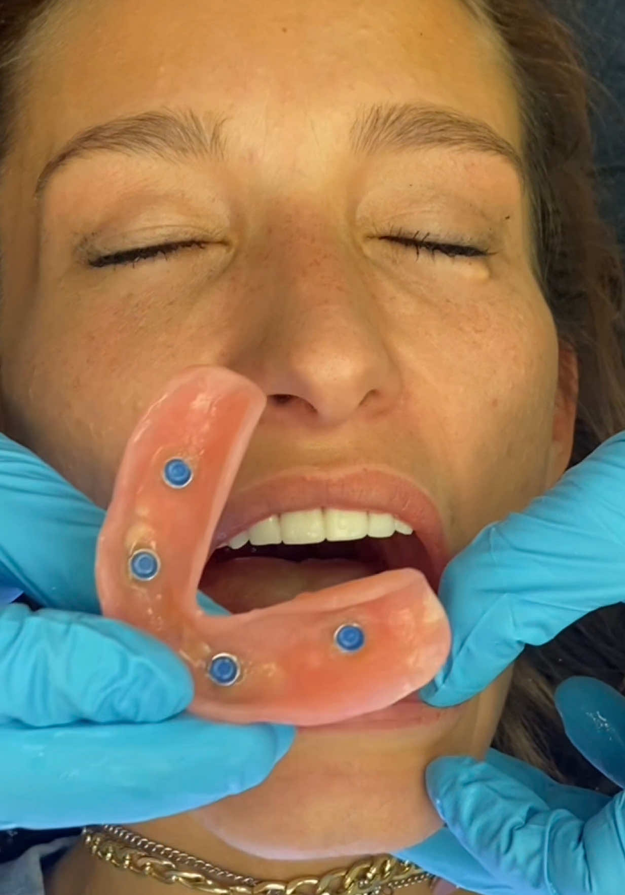 PART 2 The moment she finally saw the smile she never thought she’d have again 🥹 #reveal #beauty #drkennysmiles 