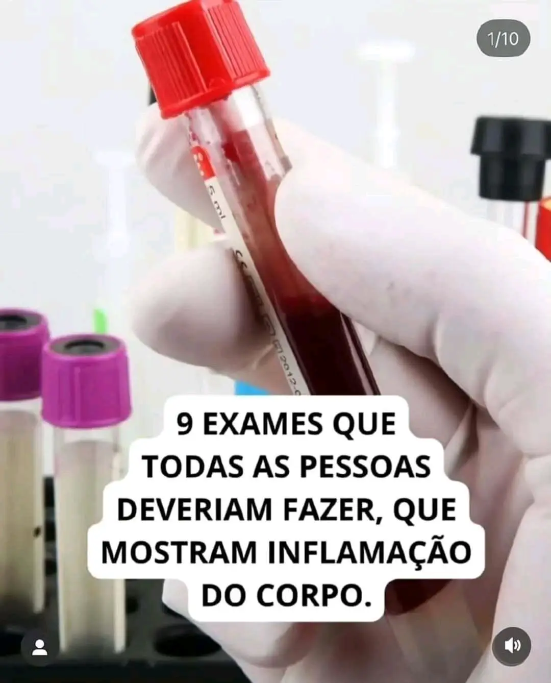 🩺✨ 9 Exames que Revelam a Inflamação no Seu Corpo! 🔍💪 Você sabia que a inflamação silenciosa pode afetar sua saúde? Aqui estão 9 exames essenciais que podem te ajudar a identificar e cuidar desse problema: 1️⃣ Insulina: Níveis altos podem indicar resistência insulínica e inflamação. Fique atento! ⚡️ 2️⃣ Ferritina: Se estiver acima do ideal, pode sinalizar inflamação crônica. E atenção: abaixo de 50, pode causar queda de cabelo e falta de energia! 😱 3️⃣ PCR (Proteína C Reativa): Um exame chave para detectar inflamação sistêmica. 🧪 4️⃣ Homocisteína: Níveis elevados podem indicar inflamação e aumentar o risco cardiovascular. 💔 5️⃣ Vitamina B12: Essencial para o metabolismo e saúde neurológica; a falta dela pode aumentar a inflamação. 🌟 6️⃣ Vitamina D: Baixos níveis comprometem a imunidade e elevam a inflamação. É hora de pegar sol! ☀️ 7️⃣ Gama GT: Indica sobrecarga hepática e inflamação no fígado. Cuide do seu fígado! 🍃 8️⃣ Hemoglobina Glicada: Avalia sua glicemia a longo prazo; níveis altos podem intensificar processos inflamatórios. 📈 9️⃣ Ácido Úrico: Quando elevado, pode causar inflamação e dores articulares. Cuidado com a dieta! 🍖🚫 🔍 Dica Extra: Lembre-se, ferritina abaixo de 50 pode resultar em queda de cabelo e dificuldade em ganhar massa muscular! 💡 Gostou dessas dicas valiosas? Então, não esqueça de conferir meu perfil para mais informações sobre como cuidar do seu corpo de dentro para fora! 🌿💖