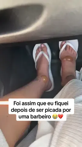 Foi assim que eu fiquei depois de ser picada por um barbeiro 😭💔 #barbeiro #chagas #hospital 