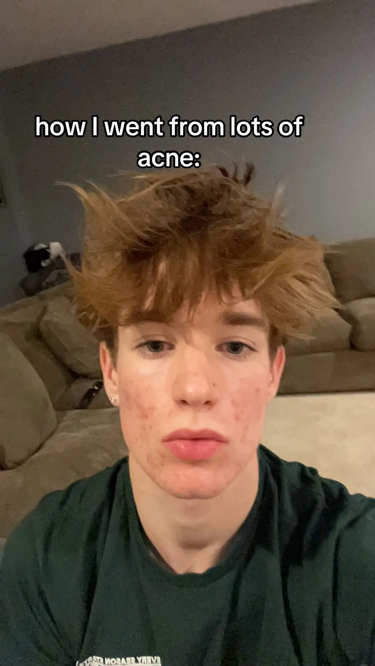 easy simple way #acne #skincare #fyp #viral