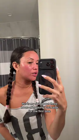 My co2 laser journey 🧖🏼‍♀️  #co2laser #skincarejourney 