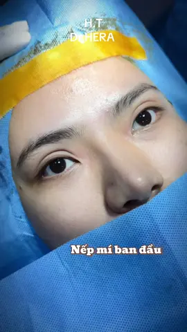 Mí sửa + mở góc trong #mí_sửa #dr #heraclinic #viral 