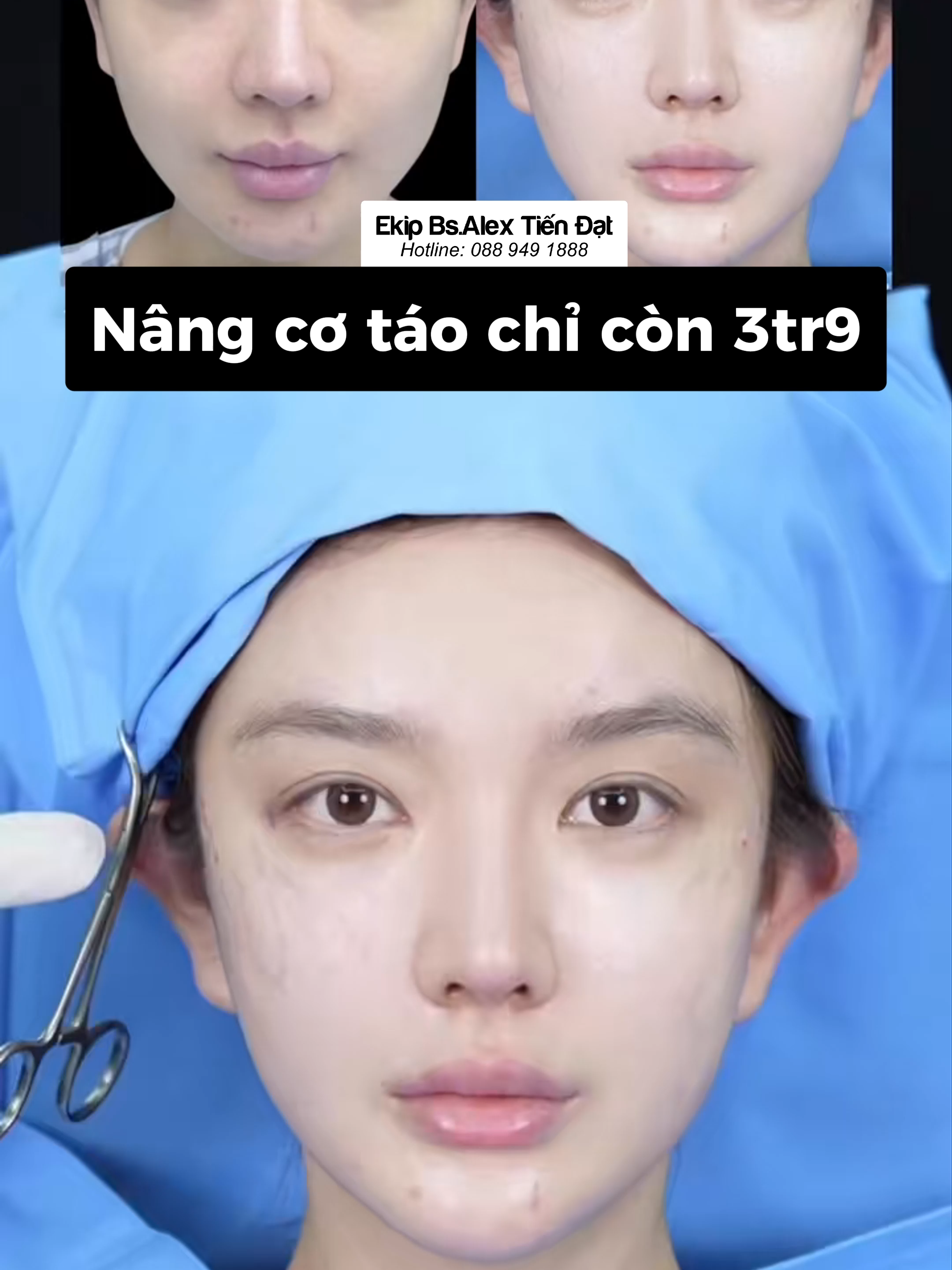 Tầng mặt giữa được nâng lên khiến khuôn mặt trẻ trung tức thì 🥰 Nâng cơ táo chỉ còn 3tr9!!! Đặt lịch ngay hôm nay #Ekipbsitiendat #BsiAlexNguyen #nangcungmay #bacsiTienDat #miphuong #xuhuong #nangcotao #fyppp #nangmui