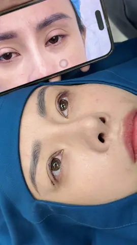 Sửa mí hạ size ghép mỡ chỉnh nhược cơ  #thammytunhien #sửamí #goclamdep #cấymotuthan 