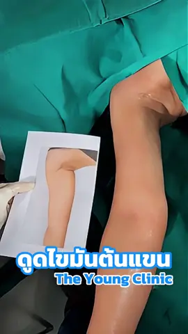 ดูดไขมันต้นแขน ไร้แผล เทคนิคเฉพาะ THE YOUNG CLINIC ✨ . #TheYoungClinic #คลินิคเฉพาะทางดูดไขมัน #คลินิกประสบการณ์16ปี #16thyearanniversary #รีวิวดูดไขมัน 