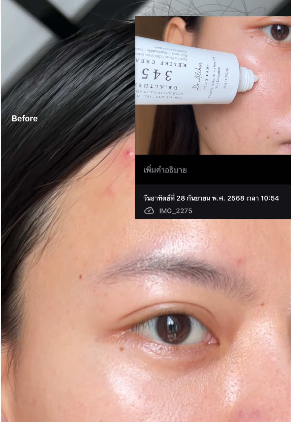 เอ้า มันดีจริง ใครเป็นสิวอยากให้ลอง #345 #dralthea #moisturizer 