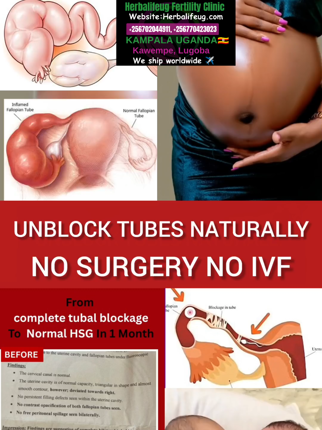 Blocked fallopian tubes, also called tubal occlusion, are a common cause of female infertility. The fallopian tubes play a vital role in transporting the egg from the ovary to the uterus, where fertilization and implantation occur. When one or both tubes are blocked, sperm and egg cannot meet, preventing natural conception. Causes include pelvic infections, sexually transmitted infections, endometriosis, prior abdominal or pelvic surgery, and adhesions. Sometimes fluid can collect in the blocked tube, known as hydrosalpinx, further reducing fertility.  ‎✅ failed to get pregnant? ‎✅Do you need yonipearls? ‎✅Do you have fibroids?  ‎✅Do you have serious menstralcramps ? ‎✅Do you suffer from bacteriavaginoisis?    ‎✅Do you have overiancyst? ‎✅Do you suffer from pid?  ‎✅Do you have pcos?  ‎✅Do you have blockedtubes? ‎✅Do you have recurring yeastinfection, candida or UTIs?  ‎✅Have you failed to get pregnant? ‎✅Do you have missingperiods?  ‎✅Do you have irregularperiods?  ‎✅Do you have heavyperiods?   ‎✅Do you have hormonal imbalance ?  ‎✅Do you suffer from infertility ‎✅Do you have endometriosis? ‎✅Do you have low sperm count ? ‎✅Do you have Azoospermia ? ‎✅Do you have weak sperms? ‎✅Do you have hydrocele? ‎✅Do you have varicocele? ‎#fertility #howtogetpregnantreallyfast #naturalremedies #concievefast #pregnant 