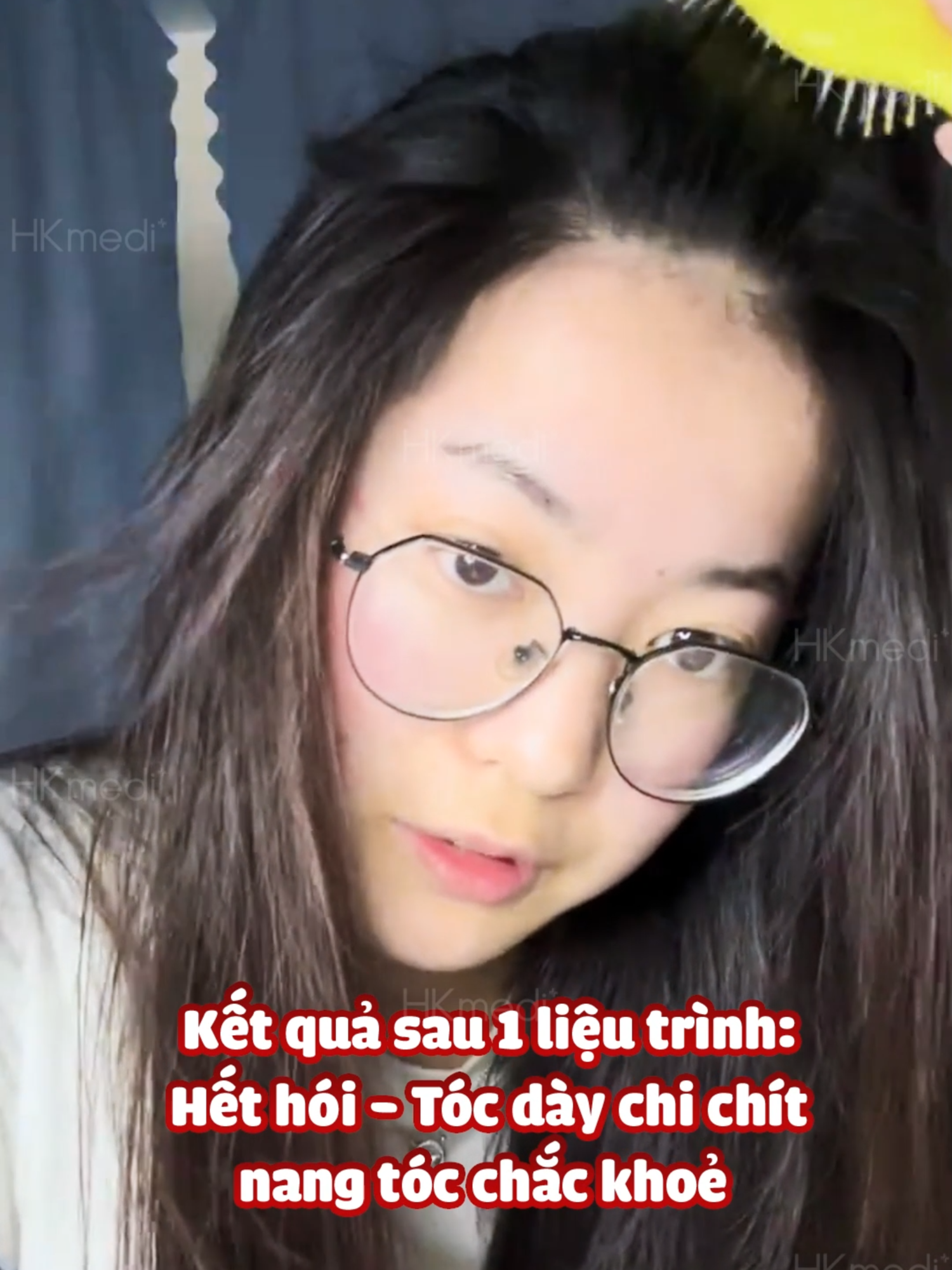 SAU LIỆU TRÌNH: HẾT HÓI - TÓC MỌC CHI CHÍT - NANG TÓC CHẮC KHỎE ➡ KIỂM CHỨNG HIỆU QUẢ BỞI 3.000+ KHÁCH HÀNG ĐÃ ĐIỀU TRỊ THÀNH CÔNG
