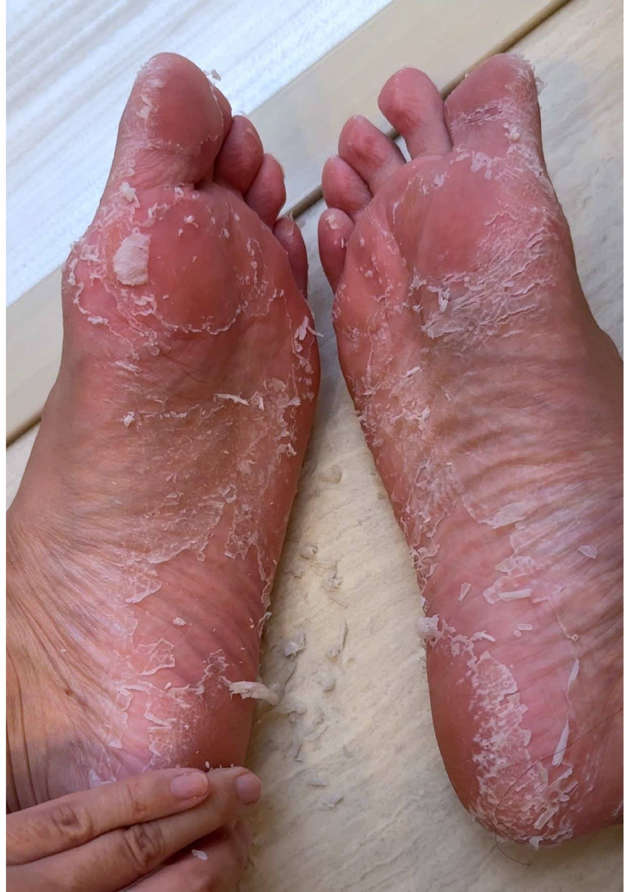 #PR #ベビーフット 足の皮眺めるの好き👣かかとガサガサな人、ぜひ試してみてね☺️ #シナモロール #フットケア #やみちゃん