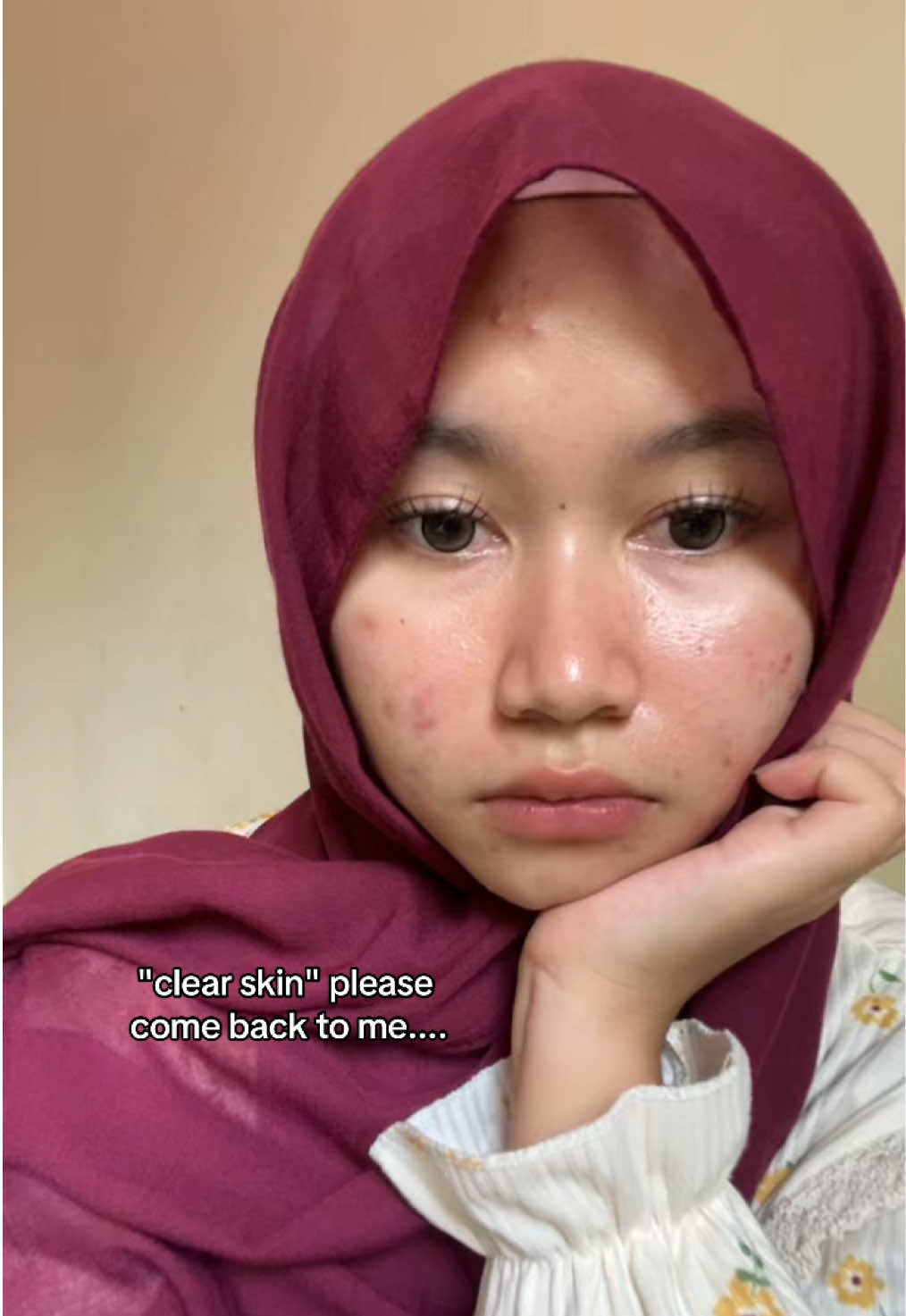 #clearskin #bareface #acne #acnefighter #jerawat 