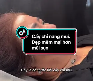 Cấy chỉ mũi#xuhuong #xuhuongtiktok #tuongtactiktok #tuongtac 