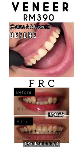 🔥 promo 🔥 • VENEER RM390 ( 8atas & 8bawah ) • FRC RM150  ( 1 BATANG ) lokasi : Klang Selangor  sebarang pertanyaan/booking sila WS :  011-61460596 🥰 #veneer #frc #malaysia #fyppppppppppppppppppppppp #fyp 