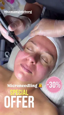 ✨ Drömmer du om perfekt glow? ✨ Microneedling ger: 💎 Fräschare hud 💎 Mindre linjer & porer 💎 Jämnare hudton Boka din behandling idag – din hud kommer älska dig! 💖#microneedling #hudvård #skincare #salonggöteborg #beauty @Hamam & Spa Göteborg 
