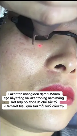 Lazer tàn nhang cực đẹp #trendingtiktok #viral #LearnOnTikTok #trendingvideo #lazer 