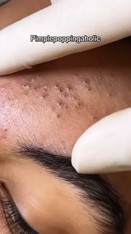 Love popping these blackheads 🫠 #fyp #foryou #SkinCare101 #skincaretip #blackheads 