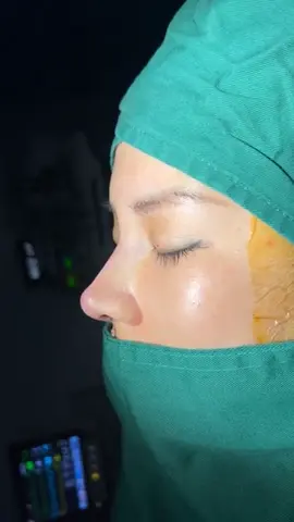 #xuhuong #nâng_mũi  #nâng_mũi_cấu_trúc  ca mũi  trung hoa vừa dứt kim xong  cho bạn khách   #nâng  