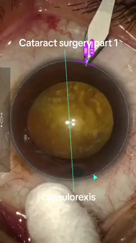 cataract surgery. capsulorexis#eyesurgery #cataract #ophthalmology 