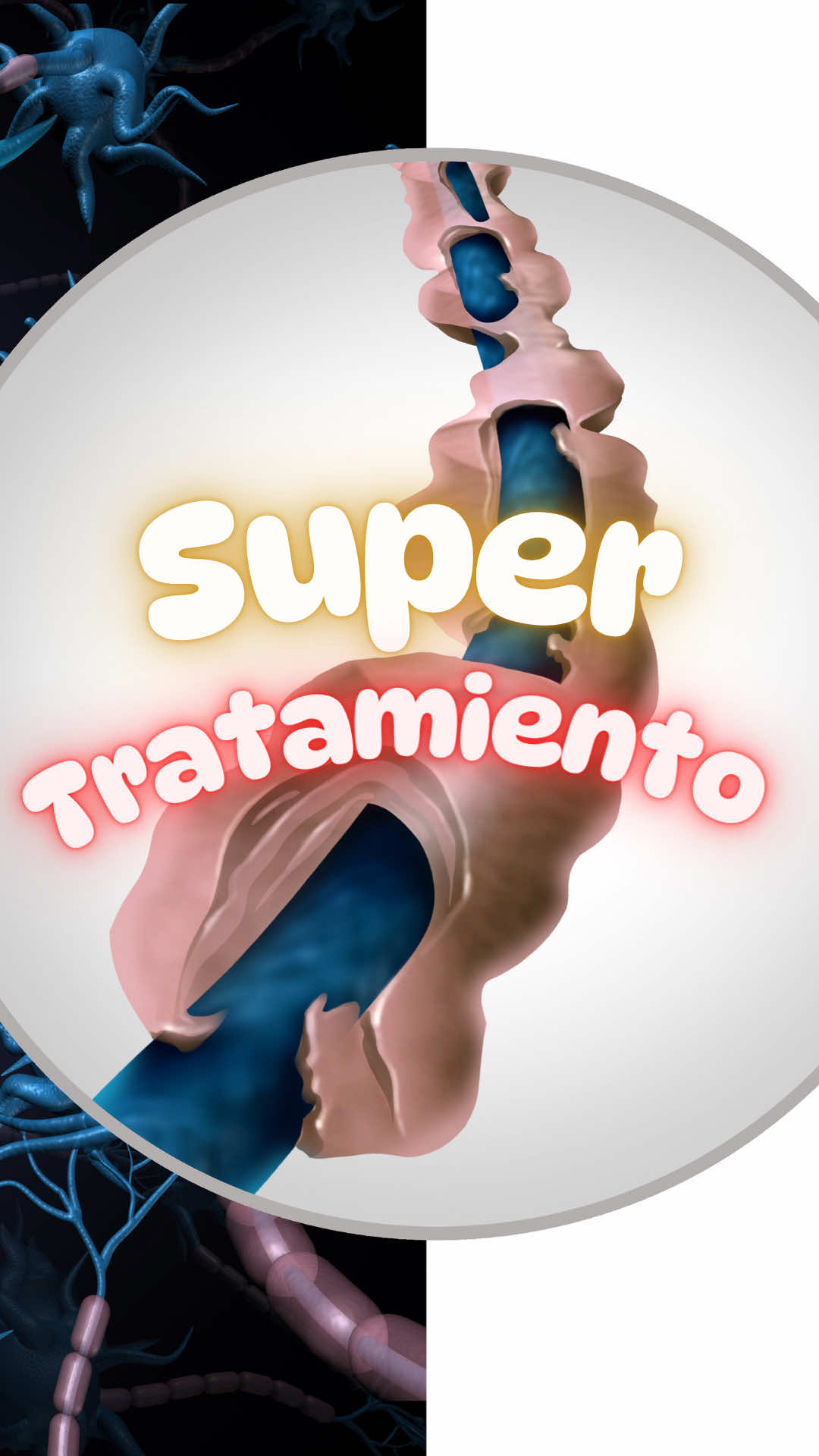 La esclerosis múltiple (EM) es una enfermedad autoinmune del sistema nervioso central en la que el sistema inmune ataca la mielina, la capa que recubre y protege las neuronas. Esto provoca problemas en la transmisión de señales nerviosas y síntomas como alteraciones visuales, debilidad, problemas de equilibrio, fatiga y trastornos cognitivos. Actualmente no existe cura, aunque sí tratamientos que ralentizan la enfermedad y controlan los brotes. Un gran reto en la investigación es lograr la remielinización, es decir, reparar la mielina dañada. En este contexto, un nuevo ensayo clínico está probando la combinación de metformina (fármaco usado en diabetes tipo 2) y clemastina (antihistamínico para alergias). Estudios preliminares sugieren que juntos podrían estimular la reparación de la mielina y mejorar la transmisión nerviosa. Los resultados iniciales del ensayo CCMR-Two, presentados en 2025, muestran señales prometedoras de reparación en personas con EM del tipo recaída-remisión. Aún es temprano para confirmar su eficacia clínica a largo plazo, pero esta combinación se perfila como una de las estrategias más esperanzadoras para no solo frenar, sino también reparar el daño en la esclerosis múltiple. #EsclerosisMúltiple #Metformina #Clemastina #Neurociencia #InvestigaciónMédica    