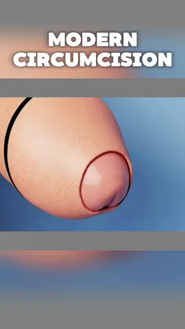 Modern Circumcision. Disclaimer: This video is for educational purposes only and is intended to raise awareness about medical procedures. It does not violate community guidelines and contains no graphic or harmful content. #HealthAwareness #MedicalEducation
