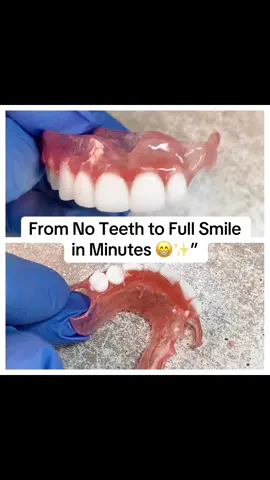 From No Teeth to Full Smile in Minutes 😁✨”Watch the amazing journey from no teeth to a complete, natural-looking smile in just minutes. Every step in the denture process is carefully crafted to bring back confidence, comfort, and happiness. Smiles truly change lives — and this transformation shows why! Hashtags (5): #DentureTransformation #SmileGoals #NewSmile #DentalCare #ConfidenceBoost