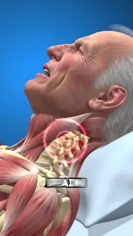 5 health conditions signaled by neck pain #neckpain #neckpainrelief #neck #pain #healthtip 