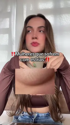 Depois me agradeçam  #estrias #cremeregenerador #celulite #lipedema 